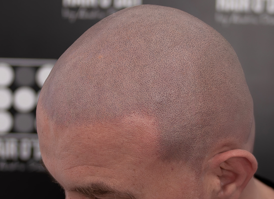 Alopecia Totalis Micropigmentare Scalp