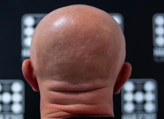 Alopecia Totalis Micropigmentare Scalp