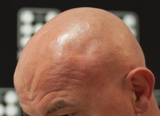 Alopecia Totalis Micropigmentare Scalp