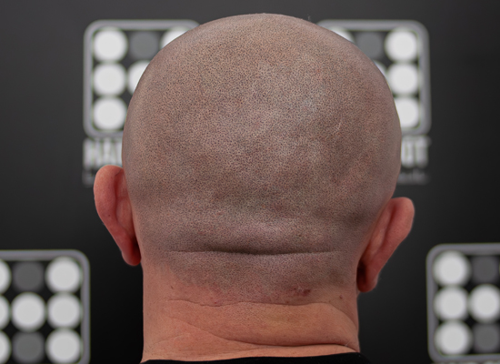 Alopecia Totalis Micropigmentare Scalp
