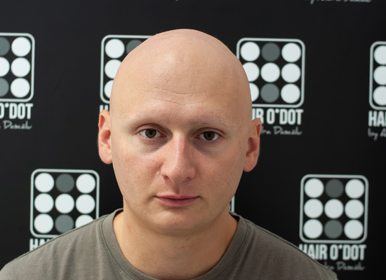 Alopecia Universalis Micropigmentare Scalp