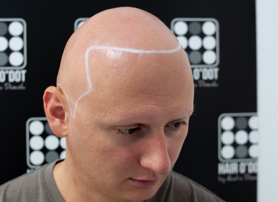 Alopecia Universalis Micropigmentare Scalp