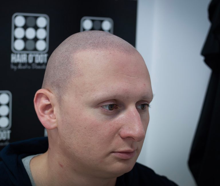 Alopecia Universalis Micropigmentare Scalp