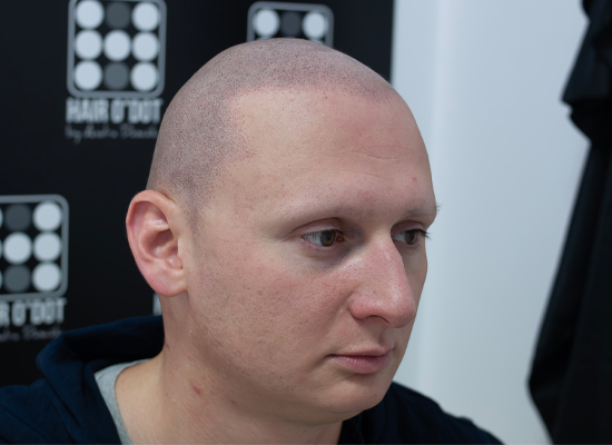 Alopecia Universalis Micropigmentare Scalp