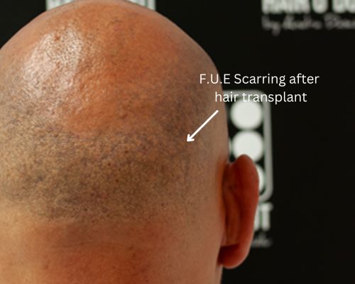 Hair Transplant FUE scars