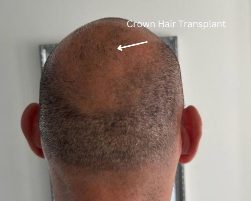 Hair Transplant Transplant de par