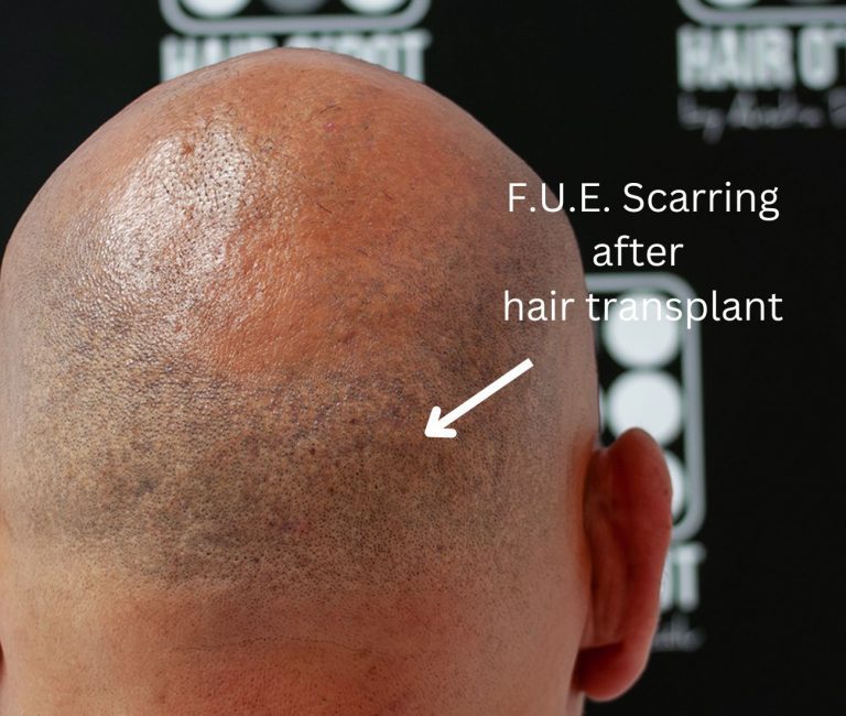 Implant de par Micropigmentare Scalp