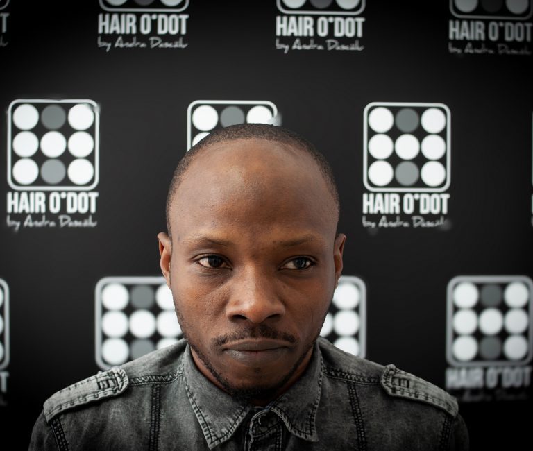 Micropigmentare Scalp Scalp Micropigmentation