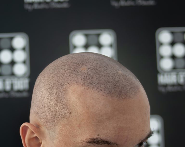 Alopecia Areata Micropigmentare Scalp Scalp Micropigmentation