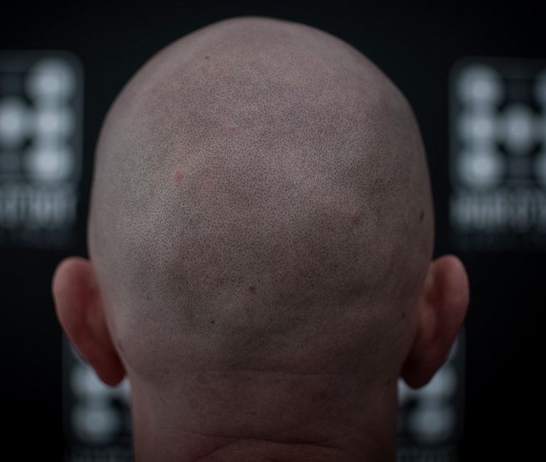 Micropigmentare Scalp Scalp micropigmentation