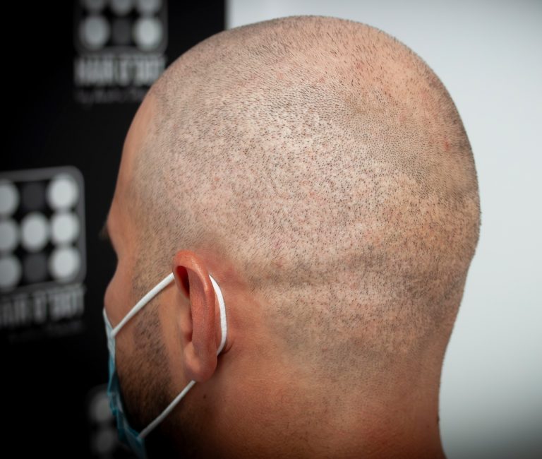 Micropigmentare Scalp Scalp Micropigmentation Cicatrici Implant de par