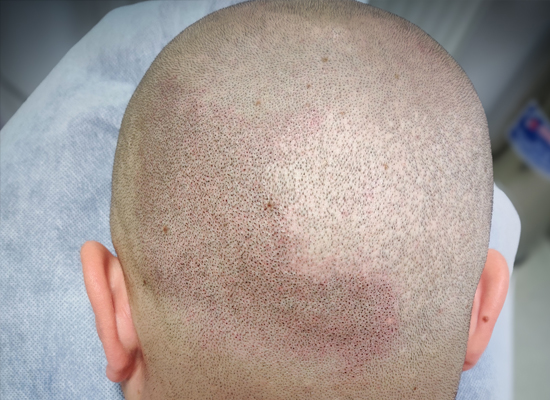 Micropigmentare Scalp Scalp Micropigmentation Cicatrici Implant de par