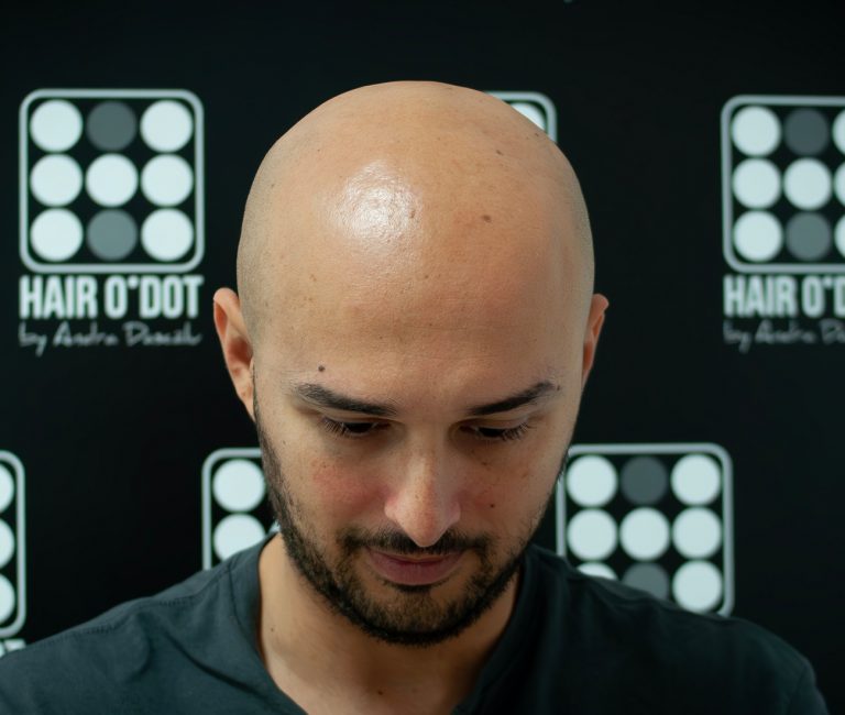 Micropigmentare Scalp Scalp Micropigmentation