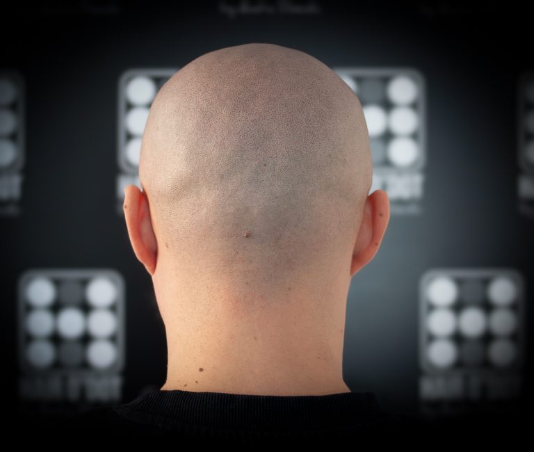 Micropigmentare Scalp Scalp Micropigmentation